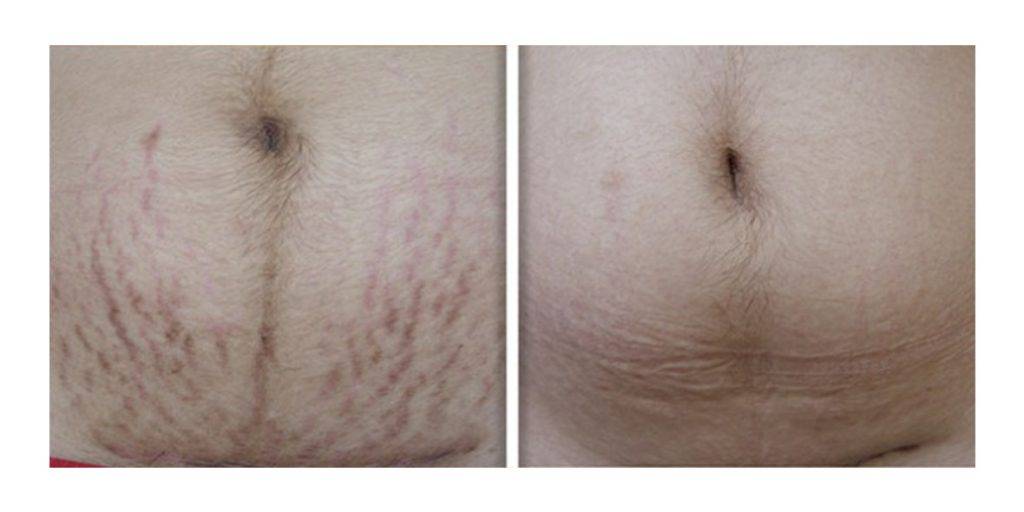 Laser Stretch Mark Removal Before and After 1