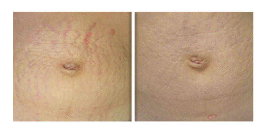 Laser Stretch Mark Removal Before and After 2