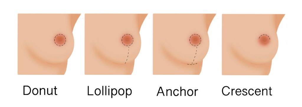 A Diagram Showing The Differnt Incisions Possible In A Brest Augmentation.