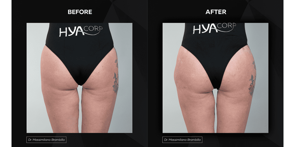 Buttock Injections Before and After 2