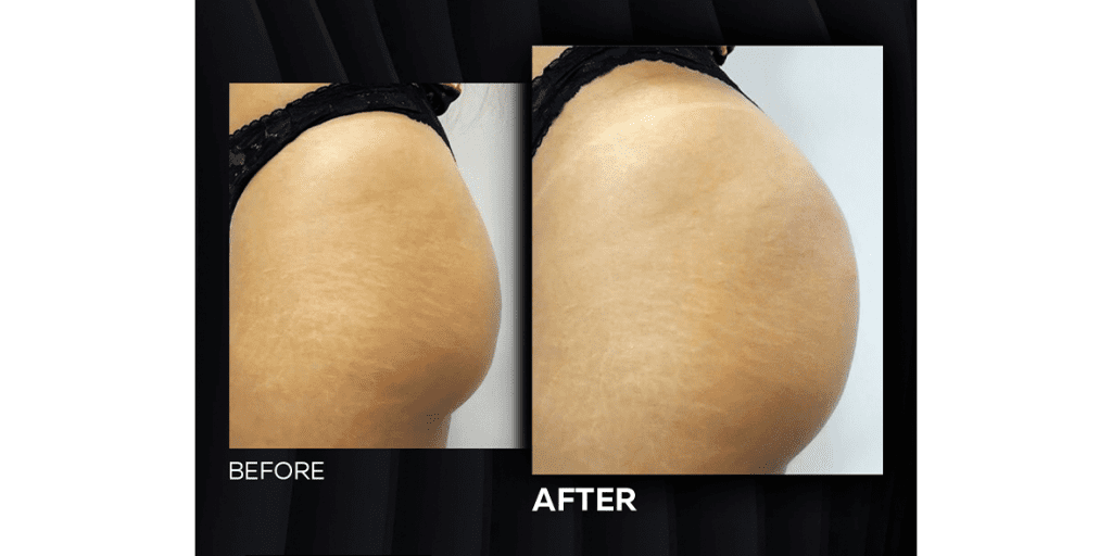 Buttock Injections Before and After 5