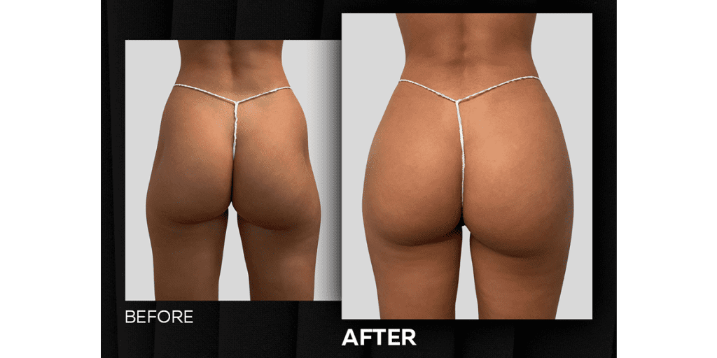 Buttock Injections Before and After 3