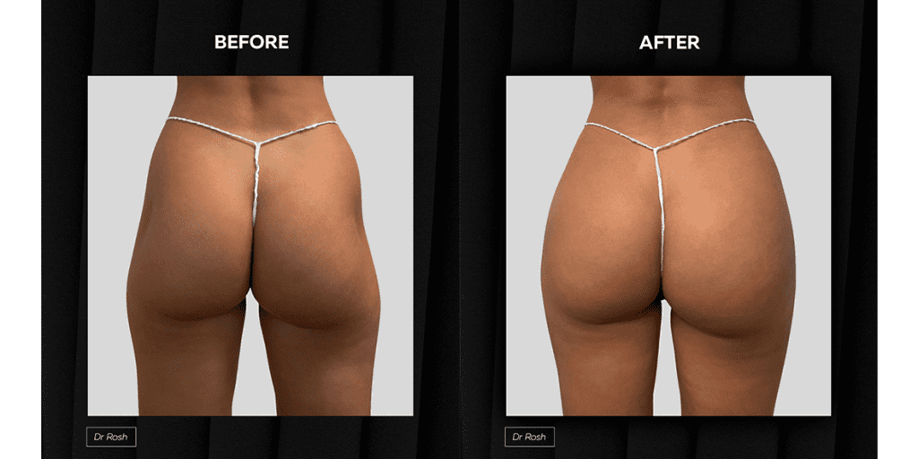 Buttock Injections Before and After 4