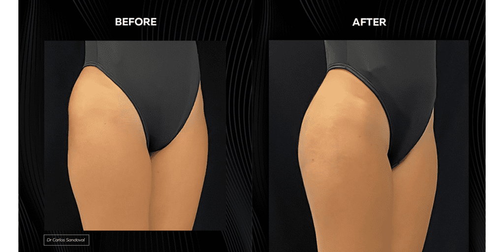 Buttock Injections Before and After 1