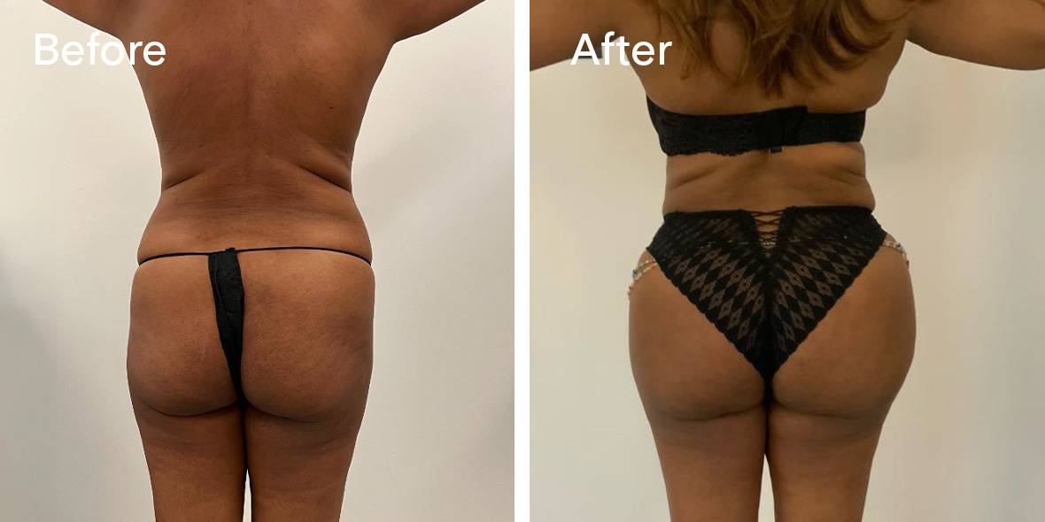 BBL BEFORE + AFTER, A BBL Brazilian Butt Lift, is a cosmetic procedure  involving fat transfer to enhance the shape and size of the but
