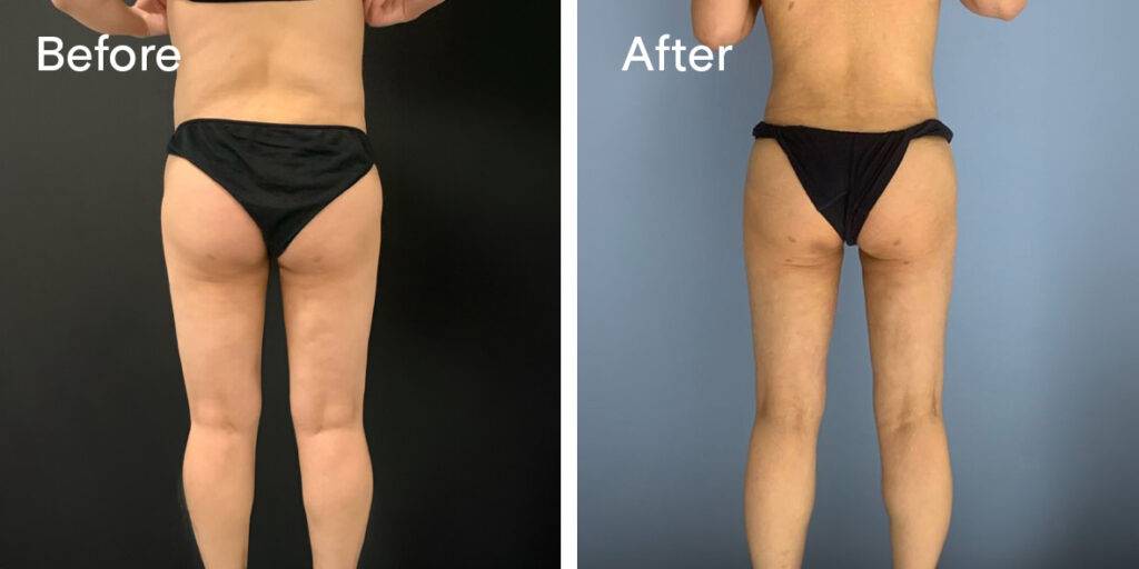 360 liposuction before and after - back