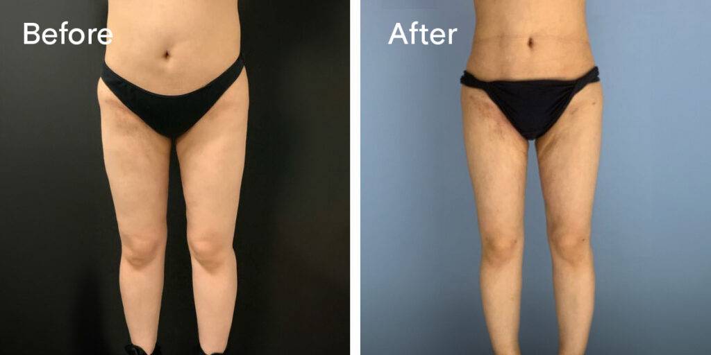 360 liposuction before and after - front