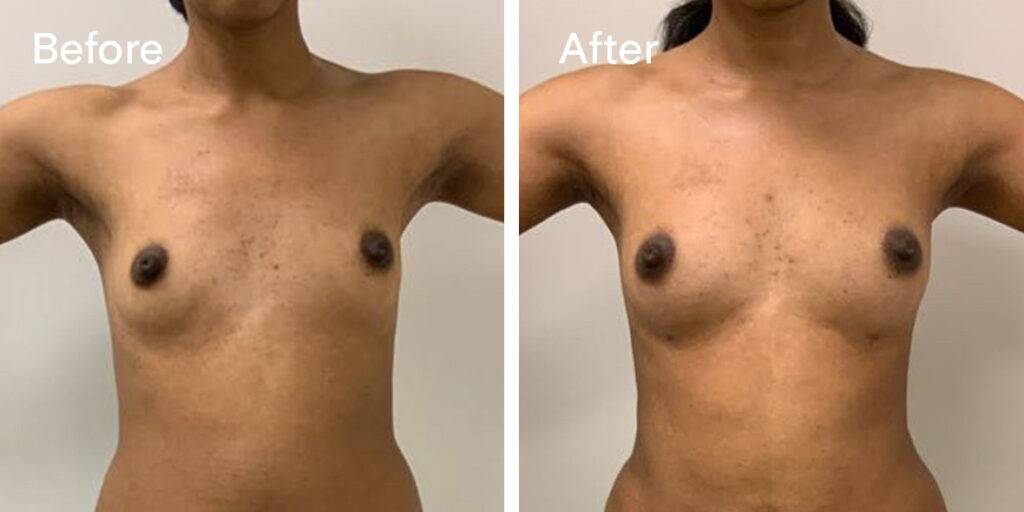 Fat Transfer Breast Augmentation Before And After 2 - Front