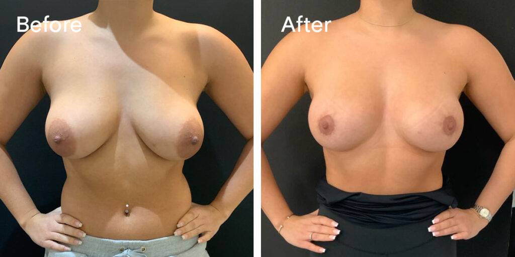 areola reduction before and after - front