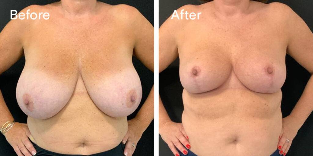 breast reduction before and after 1 - front