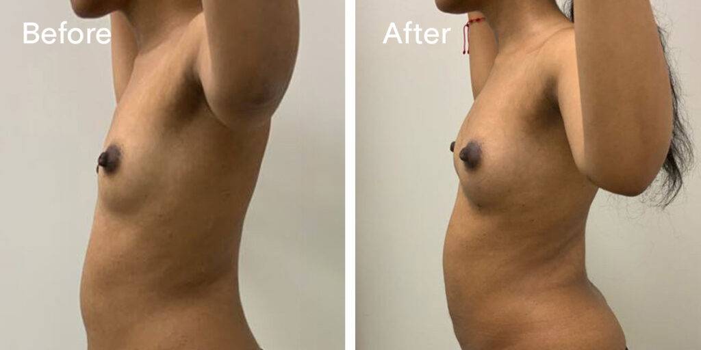 Fat Transfer Breast Augmentation Before And After 2 - Left Side