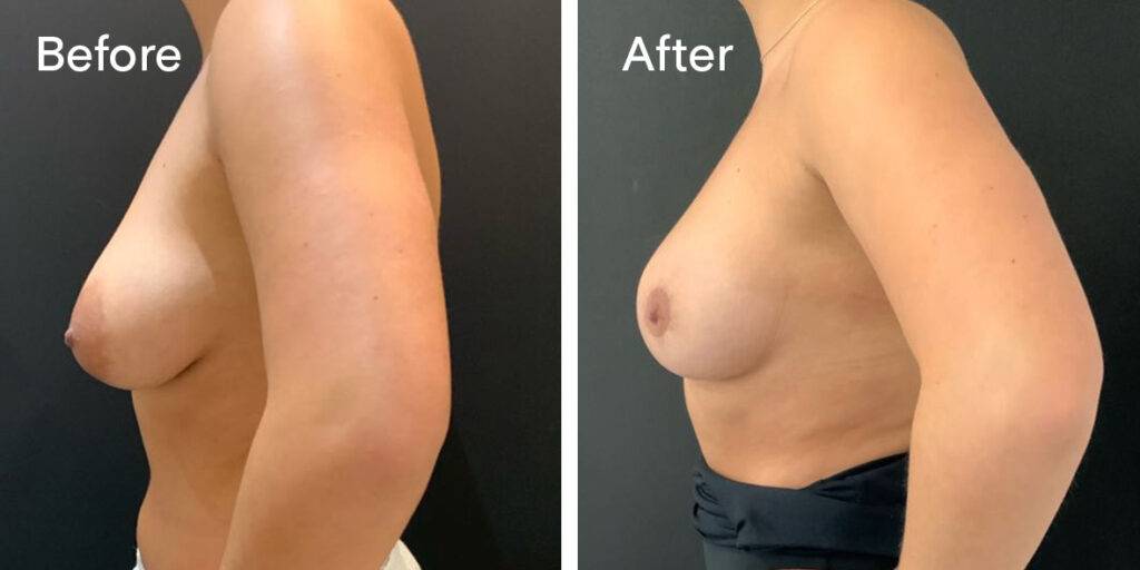 Areola Reduction Before And After - Left