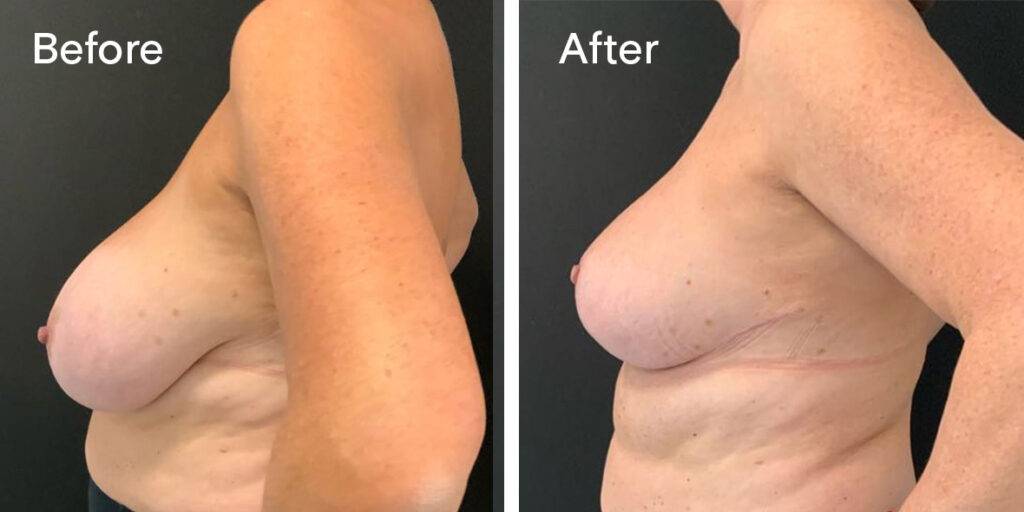 breast reduction before and after 1 - left