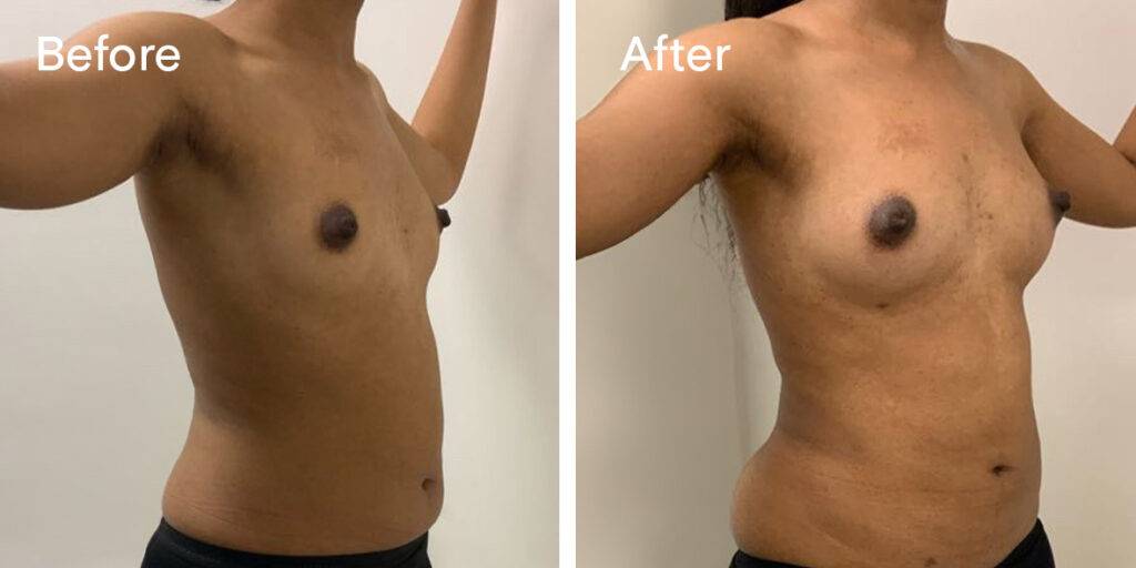 fat transfer breast augmentation before and after 2 - quarter 1