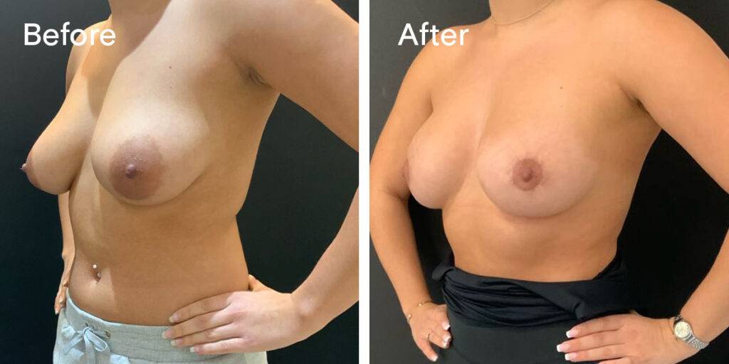 areola reduction before and after - quart1
