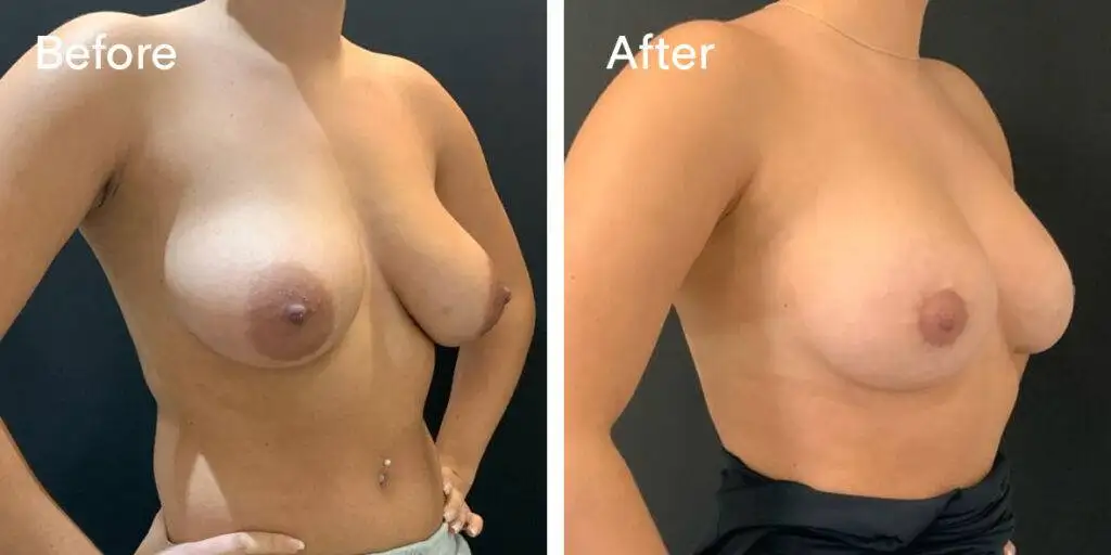 Areola Reduction Before And After - Quart2