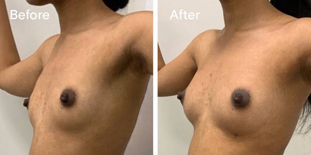 Fat Transfer Breast Augmentation Before And After 2 - Quarter 2