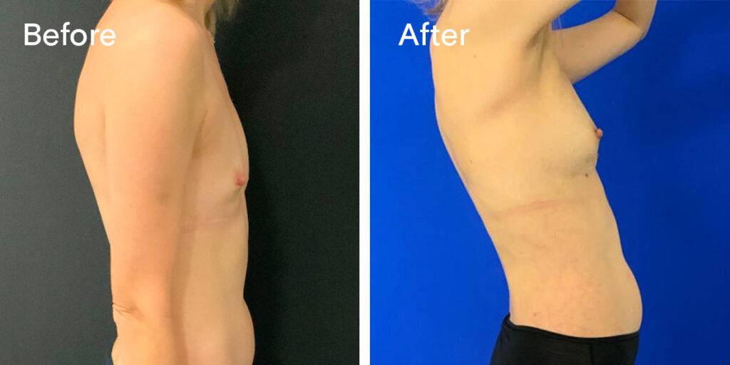 Fat Transfer Breast Augmentation Before And After - Right Side