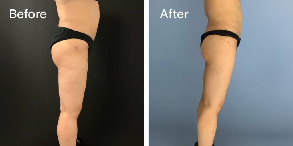 360 liposuction before and after - right side