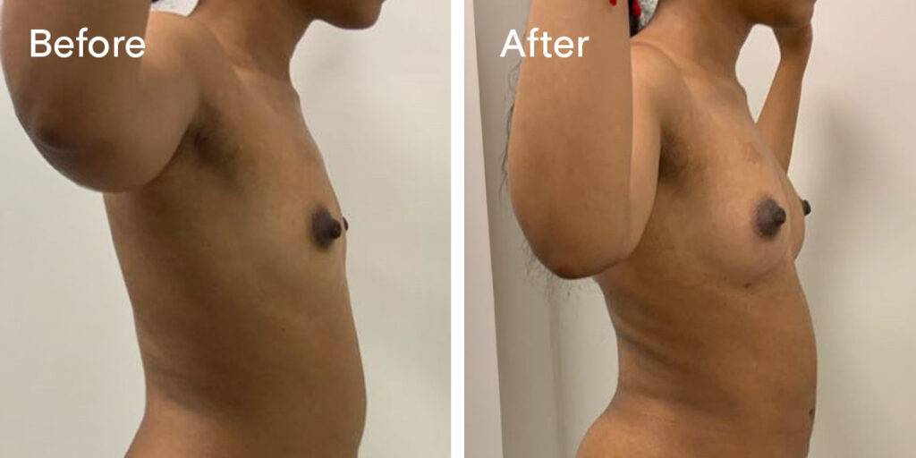 fat transfer breast augmentation before and after - right side 2