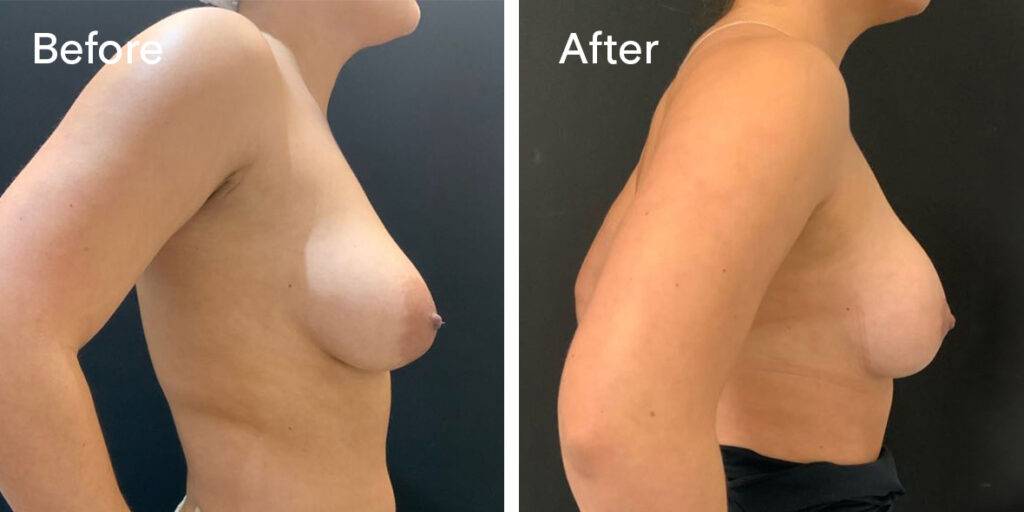 areola reduction before and after - right