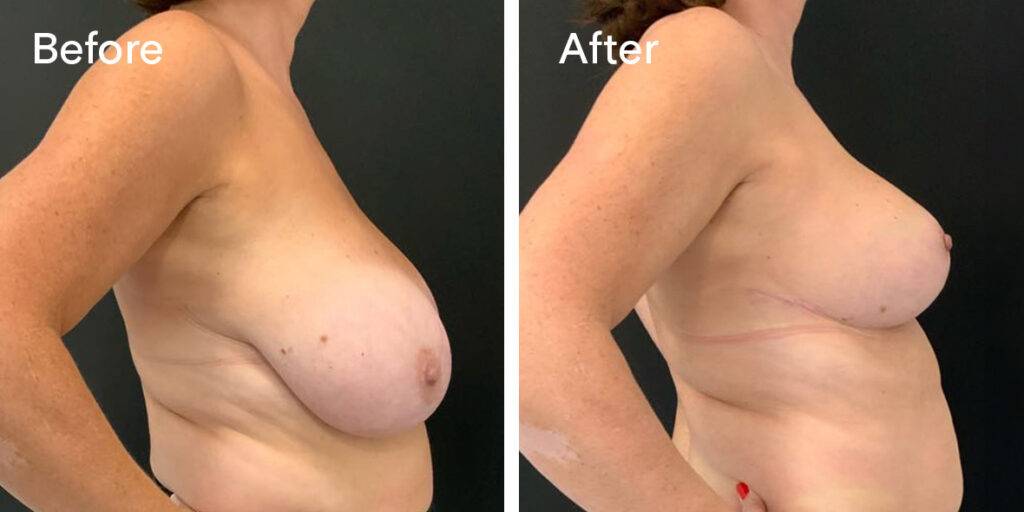 breast reduction before and after 1 - right