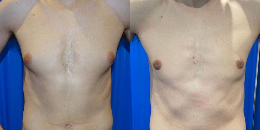 Gynecomastia From Steroid Use