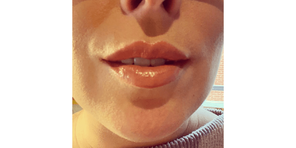 A Patient After Lip Filler