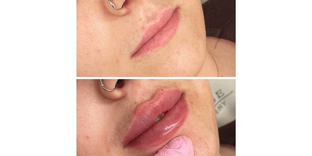 A Patient Before And After Lip Filler