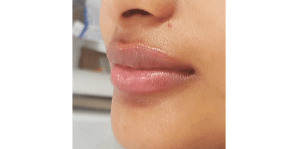 A Patient After Lip Filler