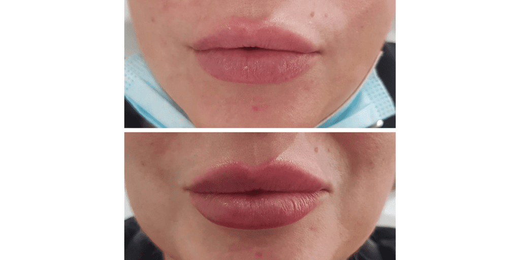 A Patient Before And After Lip Filler