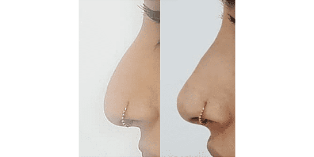 A Patient Before And After Nose Fillers