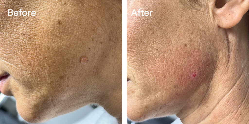 Patient before and after mole removal