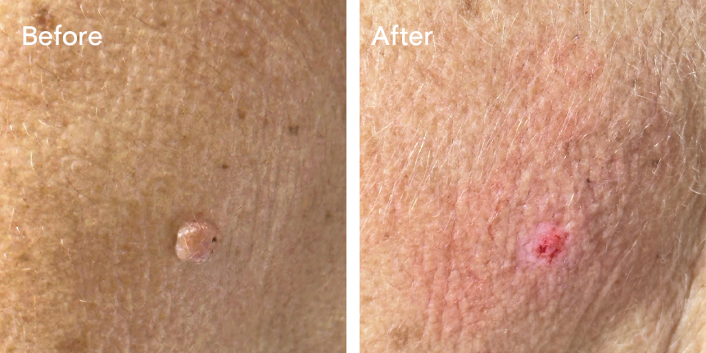 Patient before and after mole removal