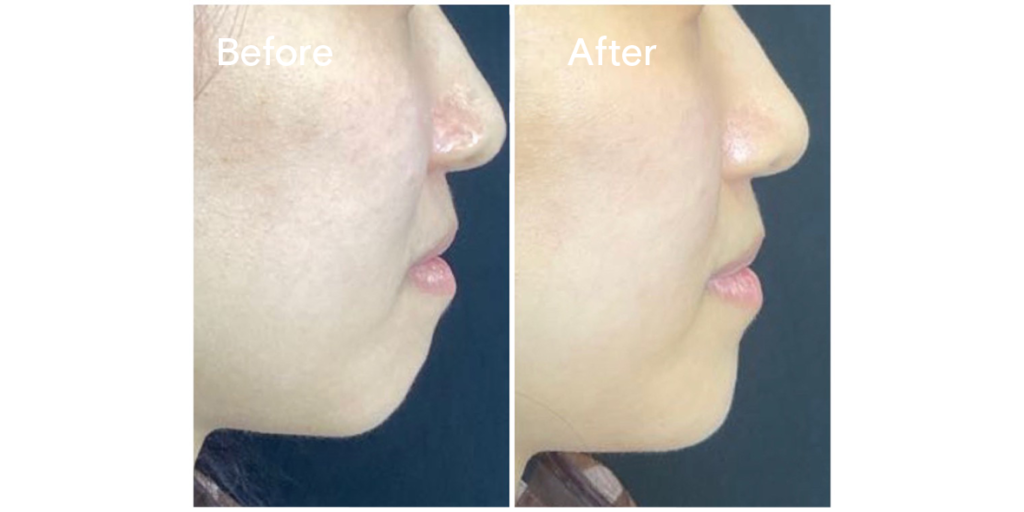 Patient before and after chin augmentation