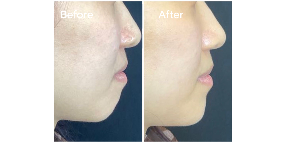 Patient Before And After Chin Augmentation