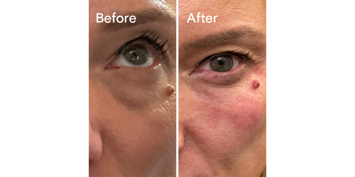 Patient Before And After Tear Trough Filler