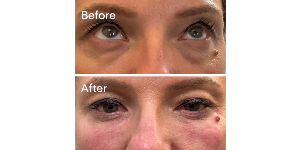 Patient Before and After Tear Trough Filler