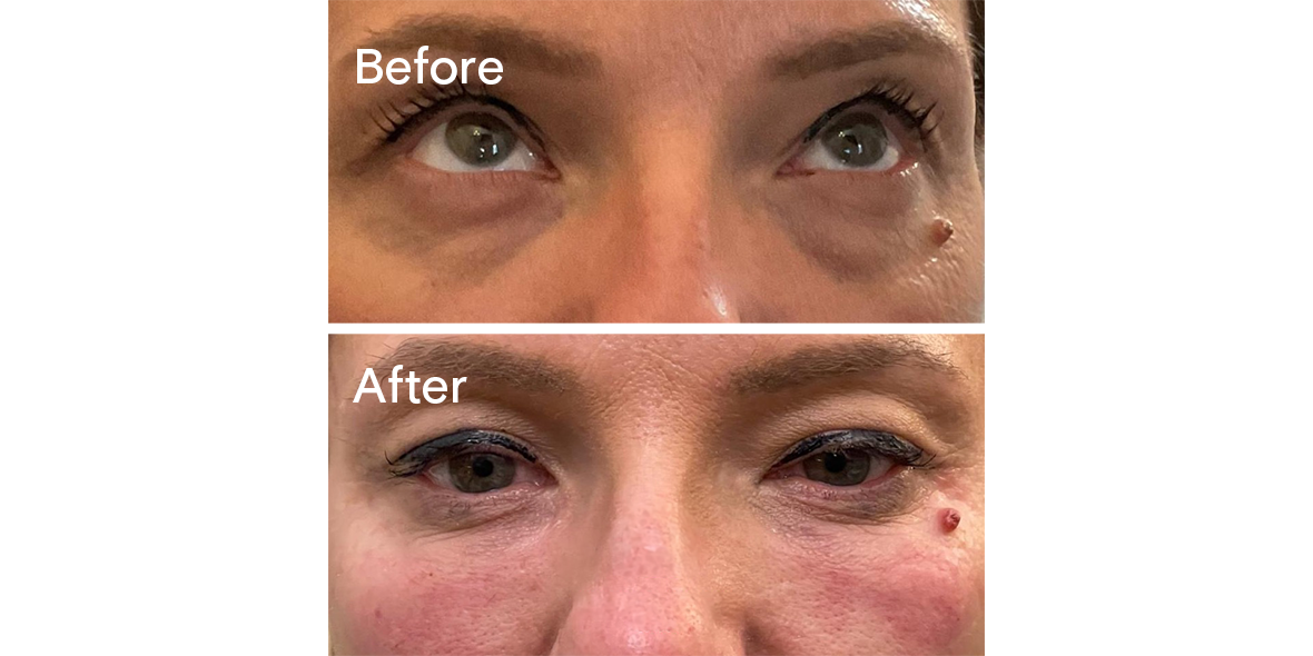 Patient Before And After Tear Trough Filler