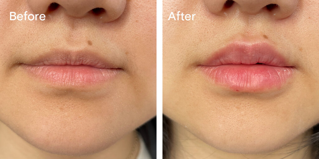 Patient before and after lip filler