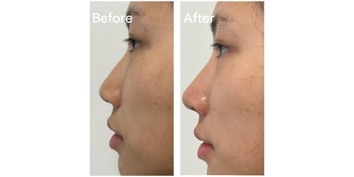 Patient Before And After Non-Surgical Rhinoplasty