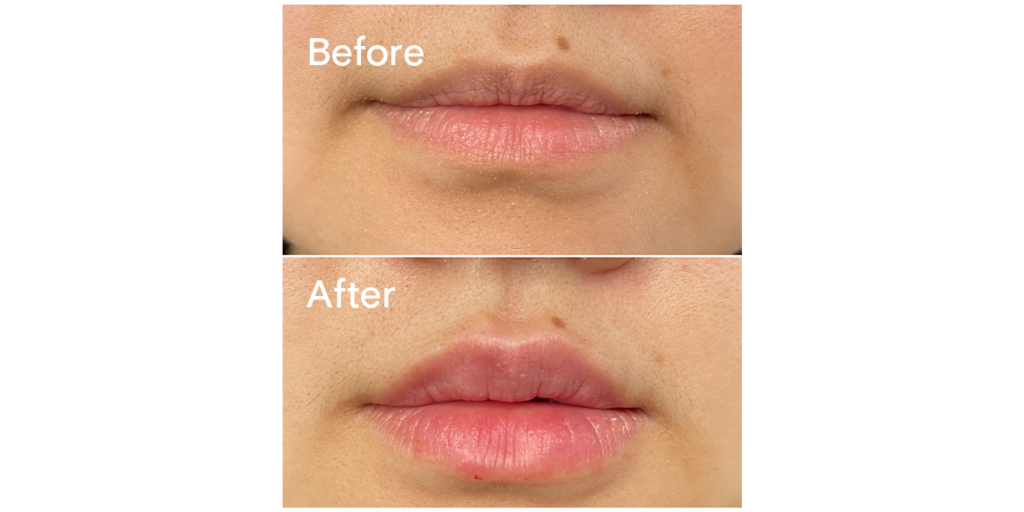 Patient before and after lip filler