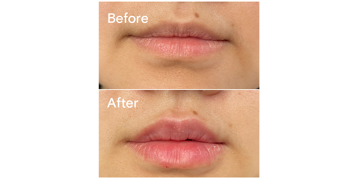 Patient Before And After Lip Filler