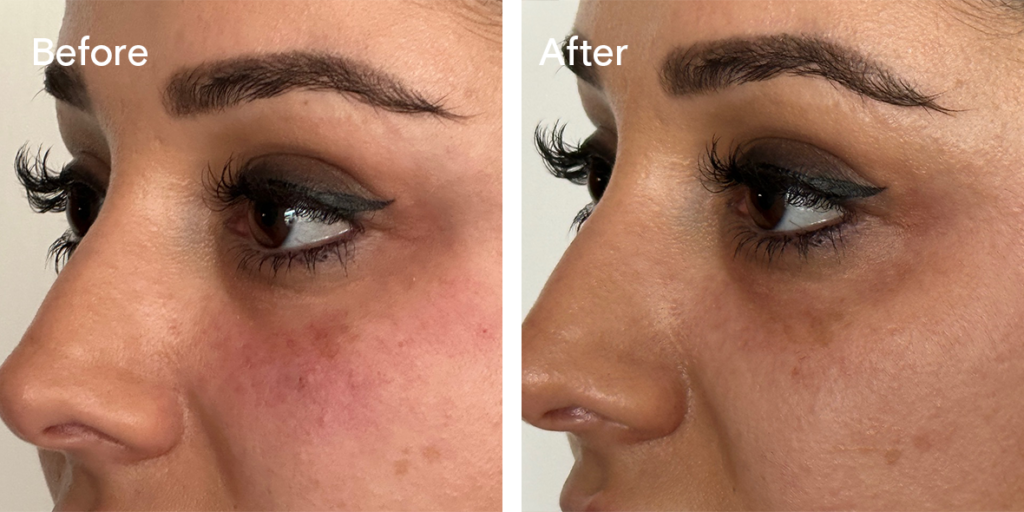 Patient Before and After Tear Trough Filler