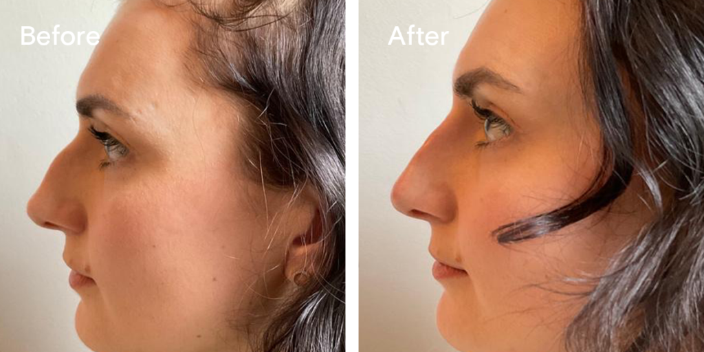 Patient before and after non-surgical rhinoplasty