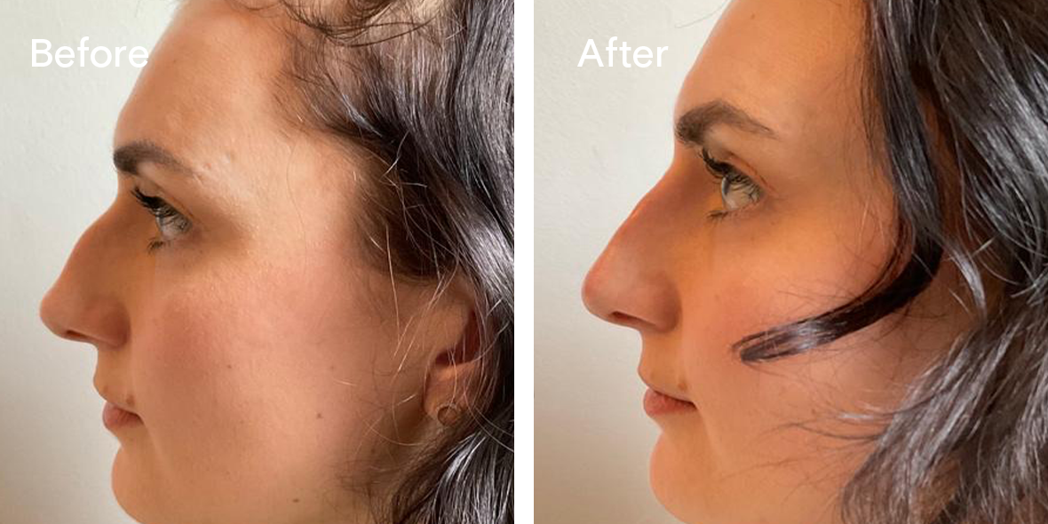 Patient Before And After Non-Surgical Rhinoplasty