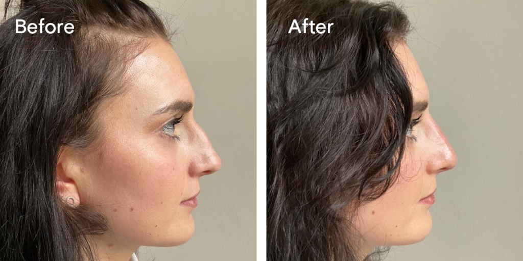 Patient before and after non-surgical rhinoplasty
