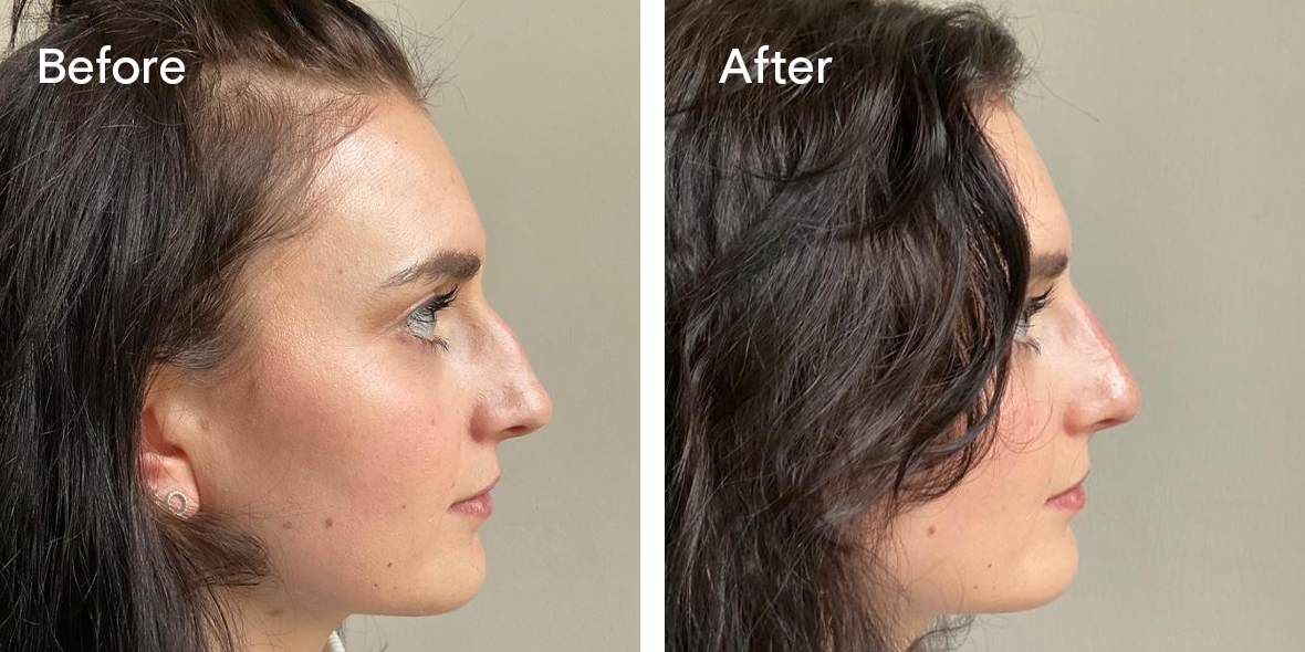 Patient Before And After Non-Surgical Rhinoplasty