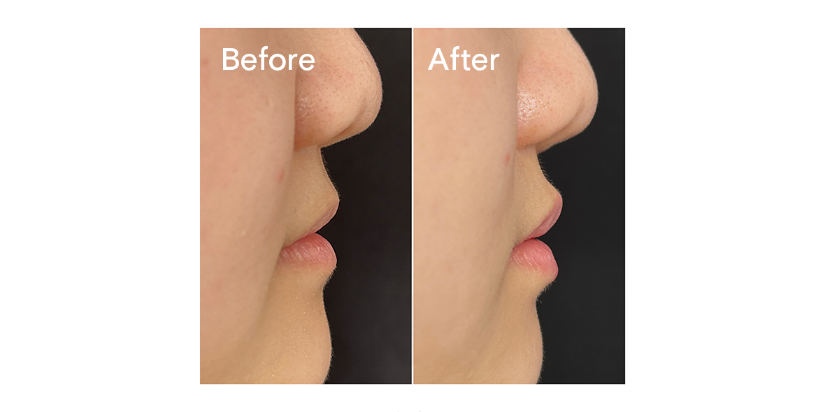 Patient Before And After Lip Filler