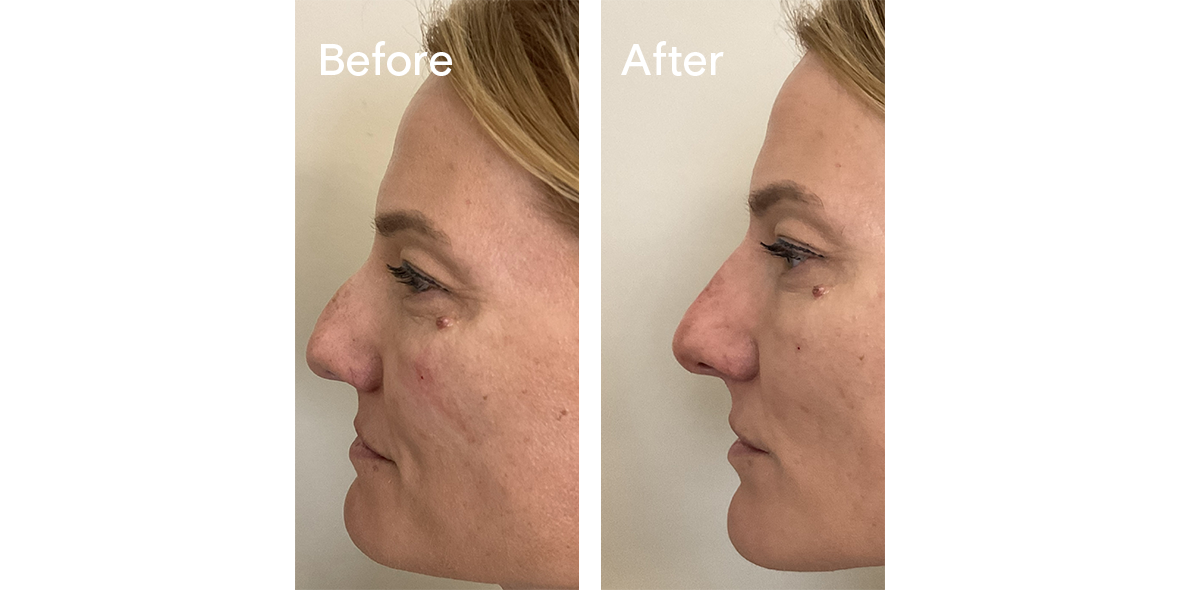 Patient Before And After Non-Surgical Rhinoplasty